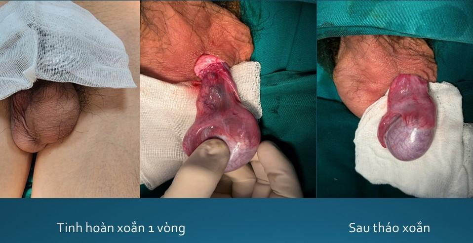 Xoắn tinh hoàn, cẩn trọng những ngày giao mùa