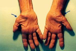   Những điều cần biết về hội chứng ống cổ tay