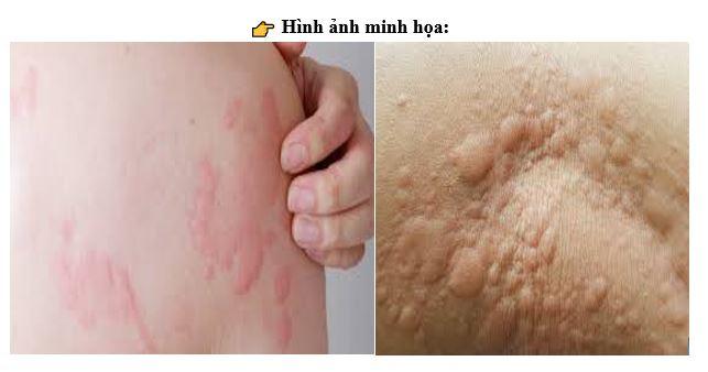 Chẩn đoán và điều trị dị ứng thời tiết