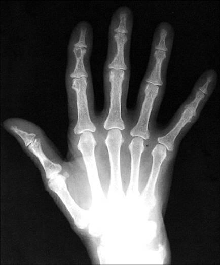 Huỷ xương bàn tay trong cường tuyến cận giáp
