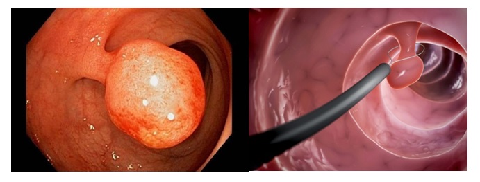 Điều trị polyp đại tràng và ung thư sớm đại tràng  bằng kỹ thuật cắt hớt niêm mạc EMR