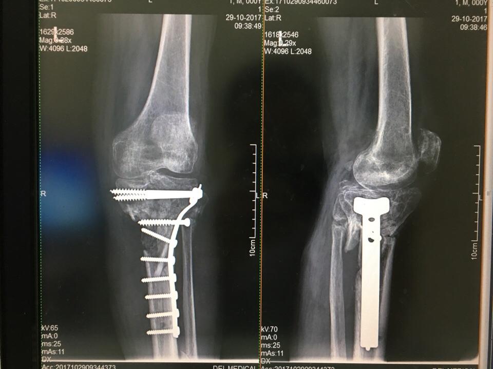 Nghị lực hồi phục sau phẫu thuật gãy 2 xương cẳng chân phức tạp của bệnh nhân cao tuổi