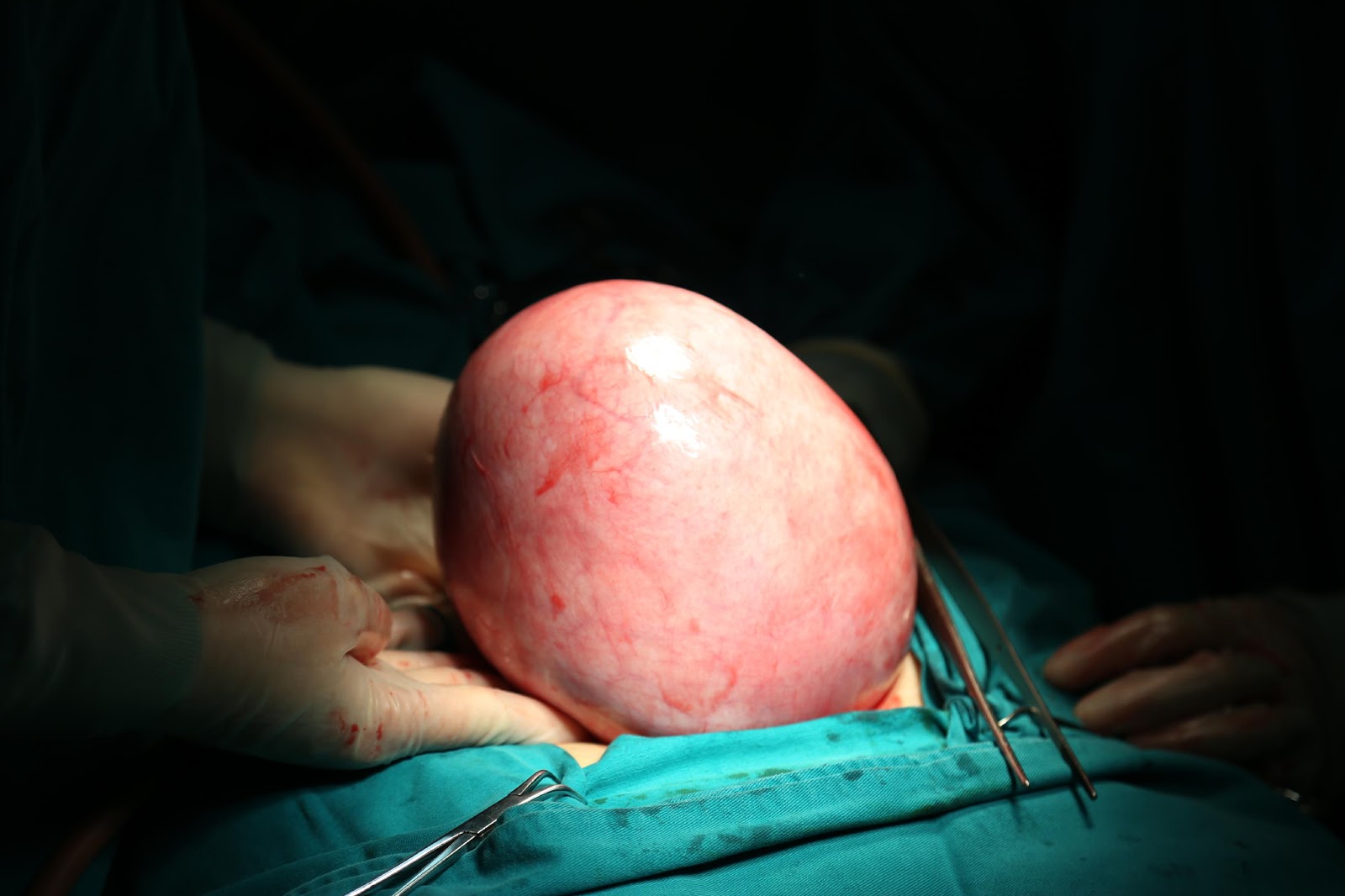Nữ bệnh nhân rong kinh kéo dài, đi khám bác sĩ phát hiện khối u 2kg ở ổ bụng