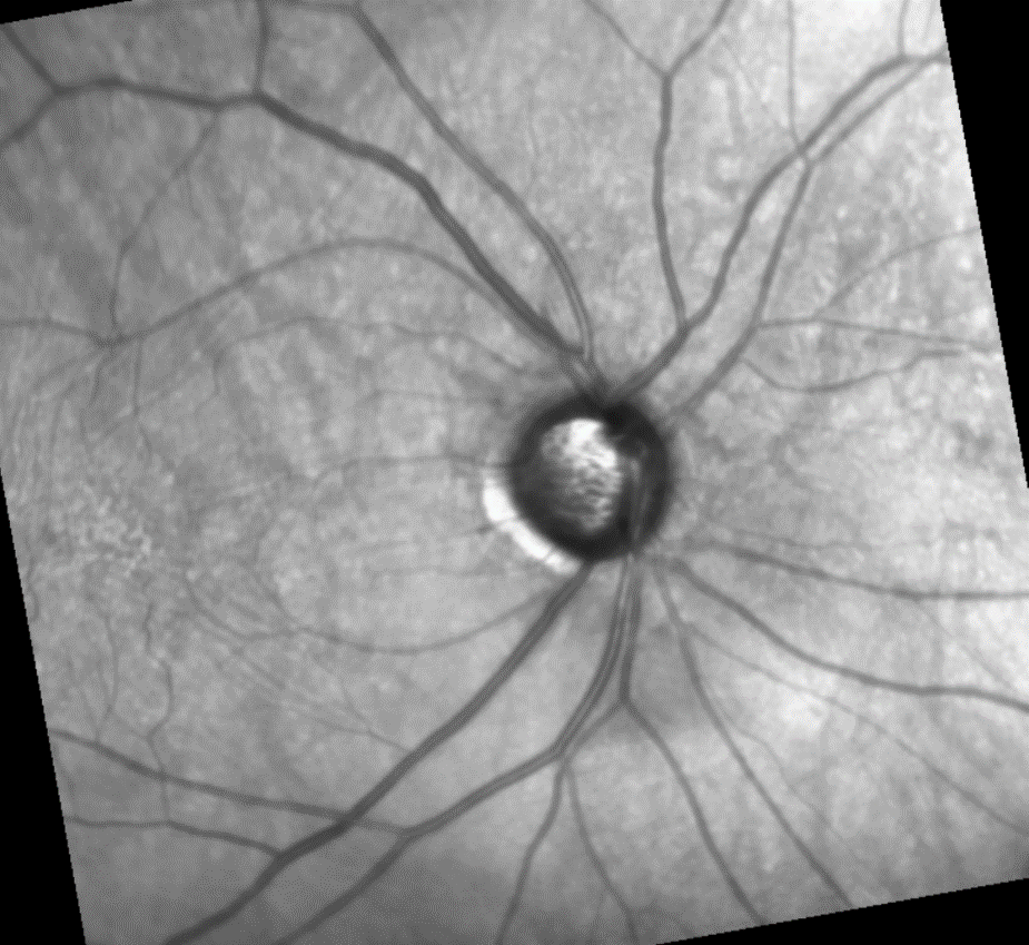 https://www.reviewofophthalmology.com/CMSImagesContent/2023/09/RP/glaucoma-mgmt-1.png