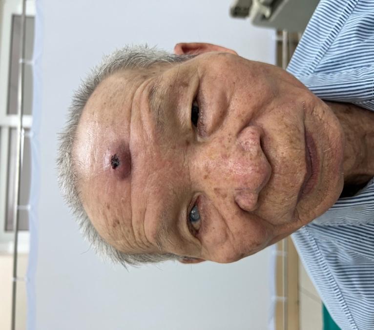 Sử dụng phương pháp phẫu thuật tạo hình trong điều trị ung thư da giai đoạn sớm cho trường hợp bệnh nhân 82 tuổi tại BVĐK Đức Giang
