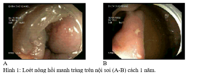 Túi thừa Meckel: biến chứng loét hồi manh tràng và thoát vị nội gây tắc ruột