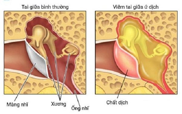 Viêm tai giữa ứ dịch: Triệu chứng, cách điều trị và phòng bệnh