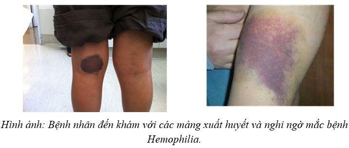 Xét nghiệm thăm dò ban đầu bệnh lý Hemophillia.
