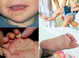 Các dấu hiệu nhận biết bệnh tay chân miệng, các dấu hiệu nặng và hướng dẫn chăm sóc, phòng lây nhiễm bệnh tại nhà
