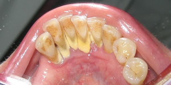 Cao răng và những điều chưa biết