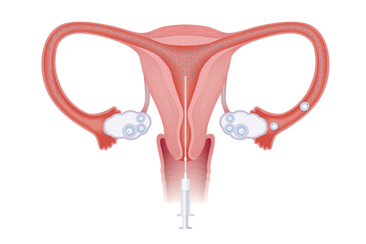 Điều trị vô sinh bằng phương pháp bơm tinh trùng vào buồng tử cung