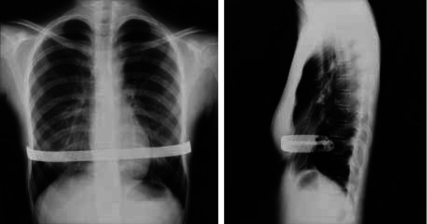 C:\Users\ngoan\Desktop\Fig-2-X-ray-findings-of-a-titanium-alloy-bar-A-Frontal-view-B-Lateral-view.png