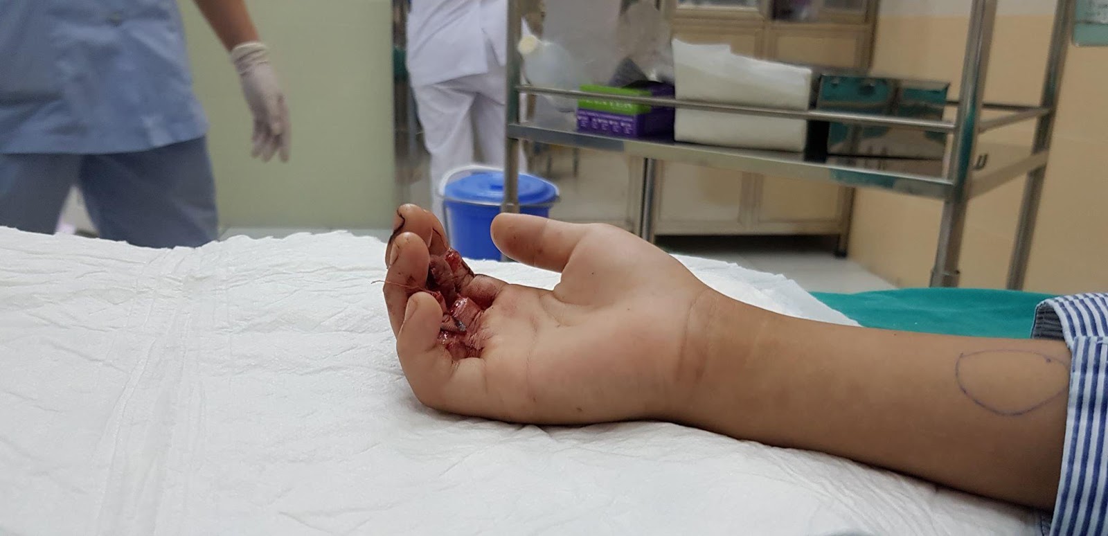 Suckhoedoisong.vn: Bé 9 tuổi suýt mất ngón tay khi bị kẹt vào thang máy