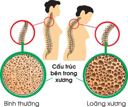 Triệu chứng loãng xương