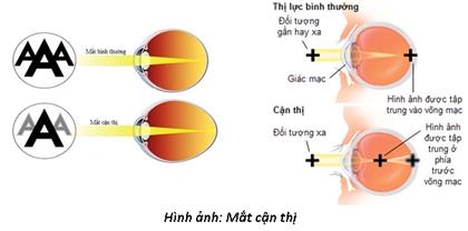 Cận thị